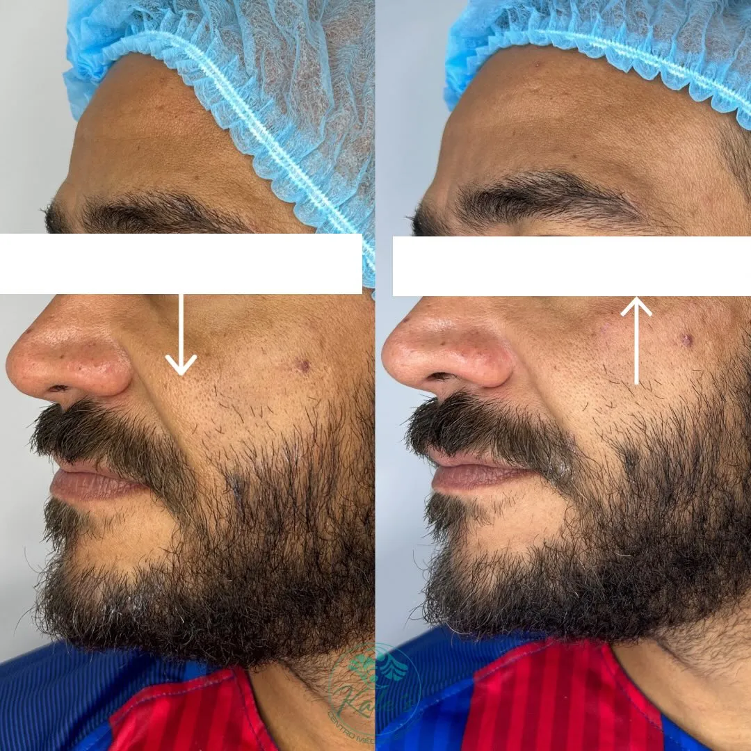 Resultado antes y después #1 de tratamiento estético en Kalé's Centro Médico Estético, Maracay