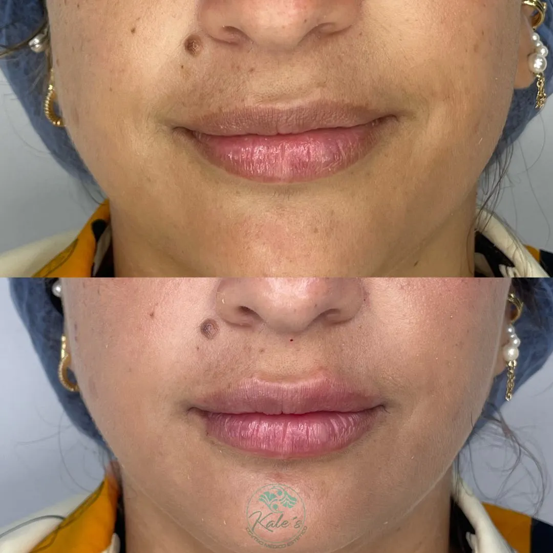 Resultado antes y después #2 de tratamiento estético en Kalé's Centro Médico Estético, Maracay