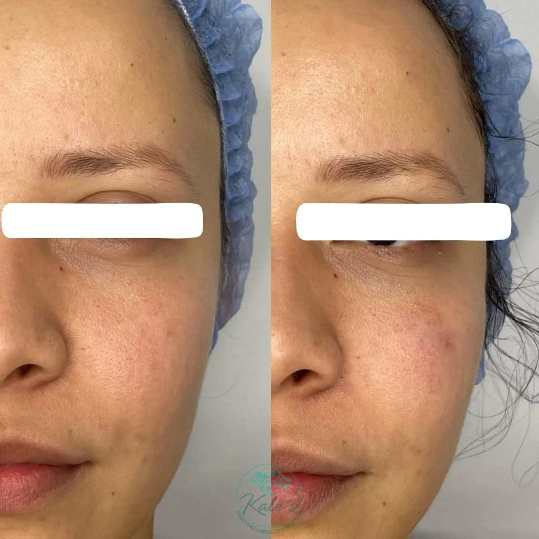 Resultado antes y después #3 de tratamiento estético en Kalé's Centro Médico Estético, Maracay