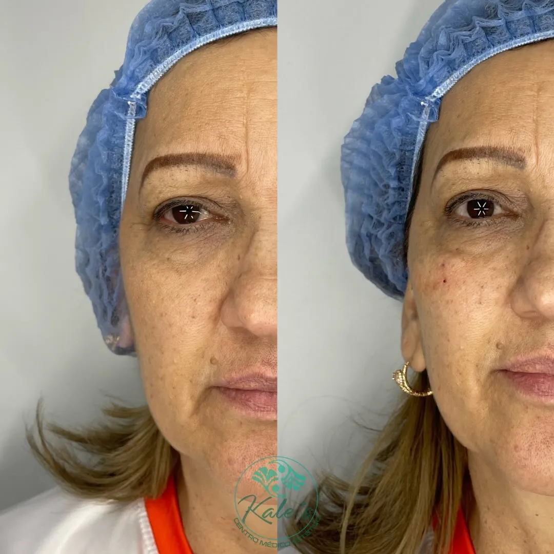 Resultado antes y después #4 de tratamiento estético en Kalé's Centro Médico Estético, Maracay
