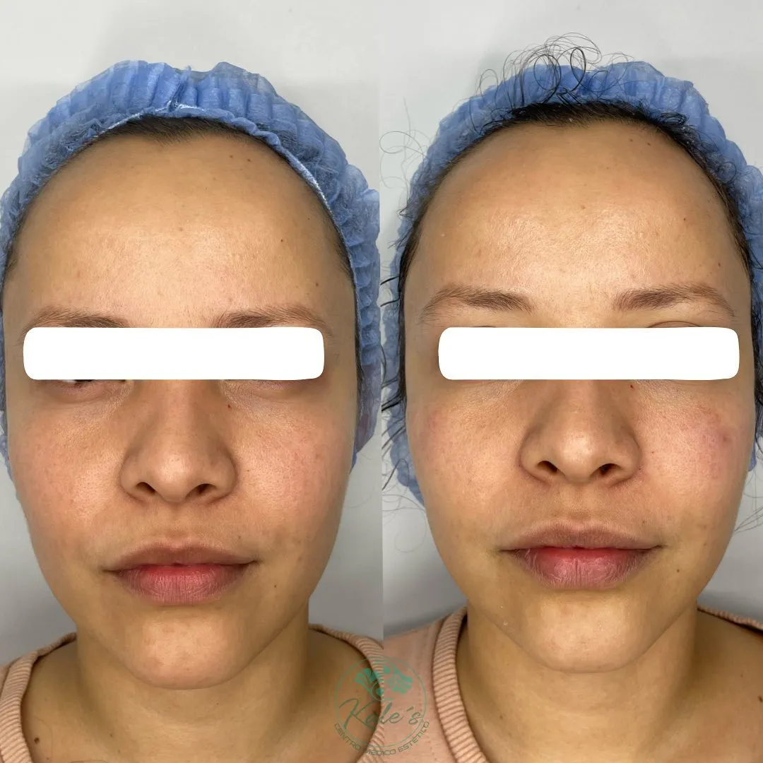 Resultado antes y después #5 de tratamiento estético en Kalé's Centro Médico Estético, Maracay