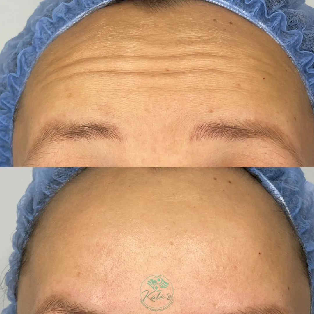 Resultado antes y después #6 de tratamiento estético en Kalé's Centro Médico Estético, Maracay